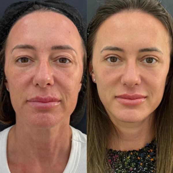 Comparativo de rejuvenescimento facial, antes e depois