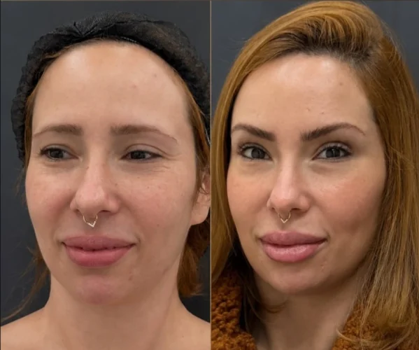 Comparativo de harmonização facial, antes e depois
