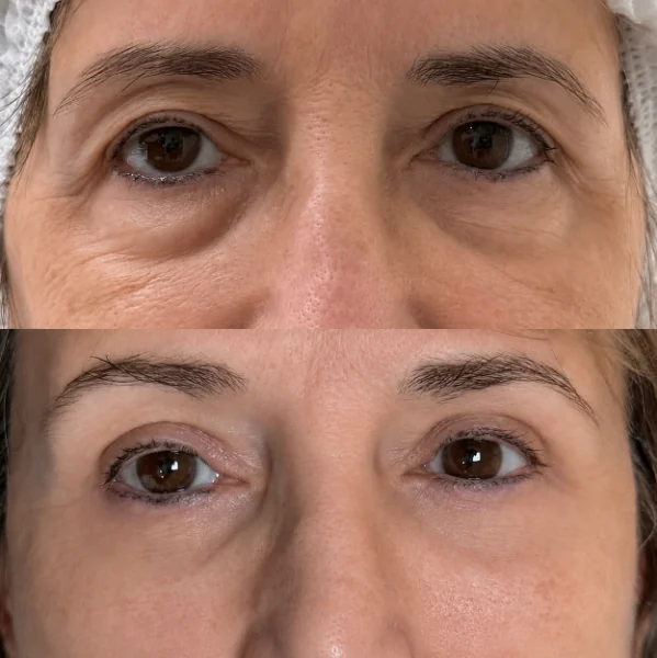 Comparativo de tratamento do olhar, antes e depois