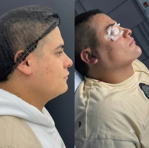 Comparativo de perfil e contorno, antes e depois