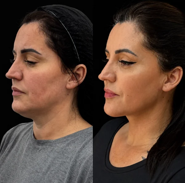 Comparativo de contorno de mandíbula e pescoço, antes e depois
