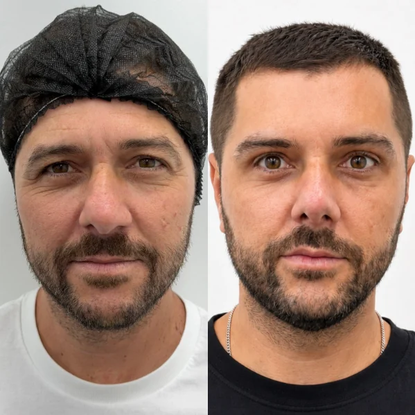 Comparativo de harmonização facial masculina, antes e depois