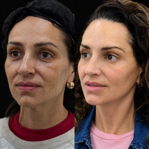 Comparativo de tratamento de pele e manchas, antes e depois