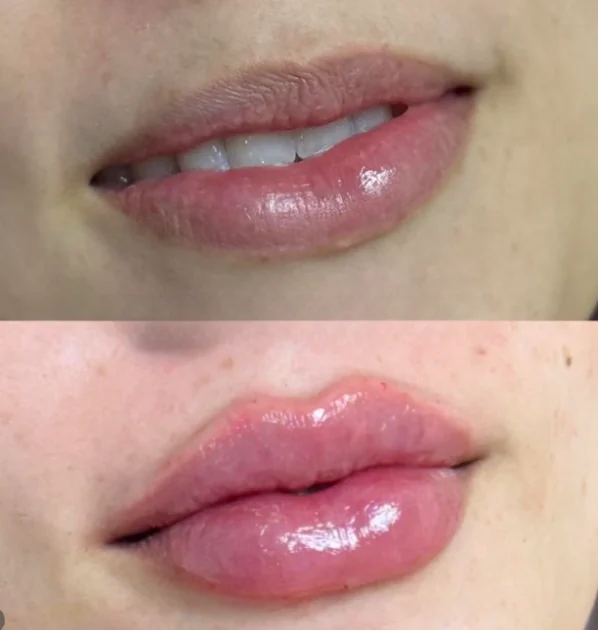 Comparativo de preenchimento labial, antes e depois