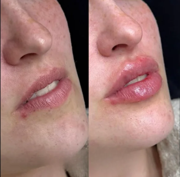 Comparativo de contorno labial, antes e depois