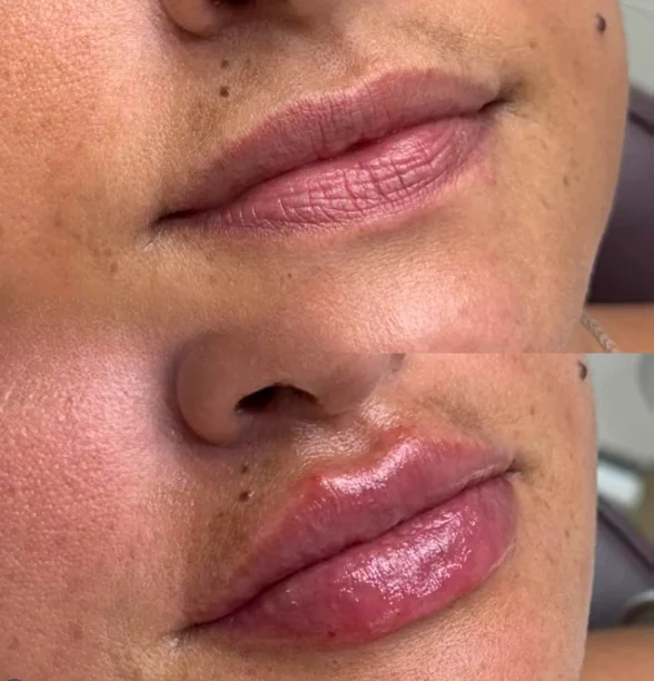 Comparativo de volume labial, antes e depois